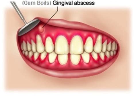 Bump On The Gums Causes And Treatment Of Symptoms Medical Information