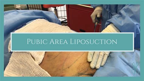 Pubic Area Liposuction Youtube