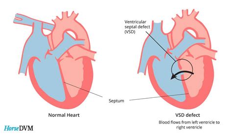 A Hole In The Heart Ventricular Septal Defects GetDoc