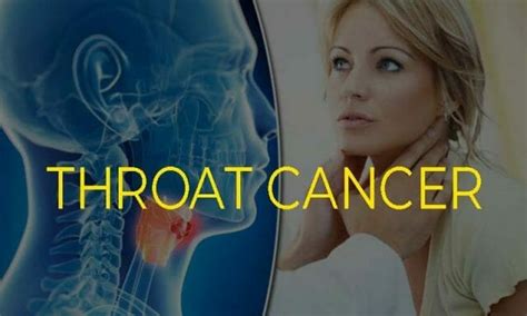 Throat Cancer Symptomscausestreatmentsandprevention