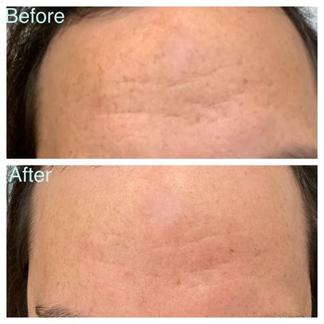 Prp Skin Facial Rejuvenation Microneedling Central Cosmedic Ltd