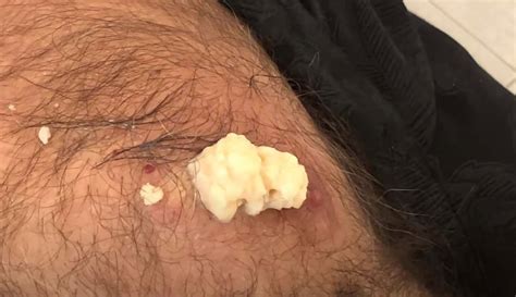 Man Pops Own Cyst New Pimple Popping Videos