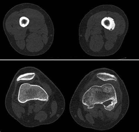 Non Contrast Ct Scans Of Femoral Osteomyelitis Secondary To Acl