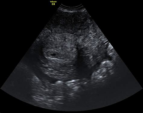 Use Of Double Decidual Sac Sign To Confirm Intrauterine Pregnancy