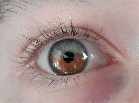 I Was Born With Sectoral Heterochromia Making My Left Eye Half Blue And Half Brown My Right Eye