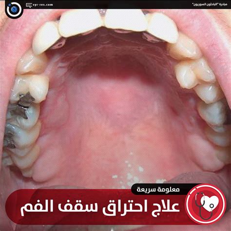 الباحثون السوريون علاج احتراق سقف الفم