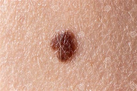 Mole Birthmark Nevus Macro Photo On Human Skin Close Up Stock Image