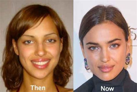 Good Before And After Plastic Surgery Pictures