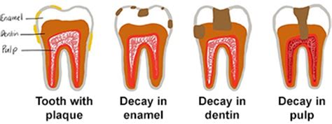 Understanding And Preventing Cavities Mouthhealthy Oral Health