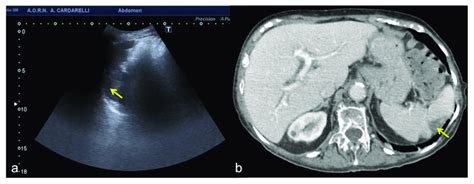 Coronal Us Scan Of The Left Hypochondrium A Shows Partial Exploration