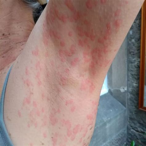 Christmas Tree Rash Pityriasis Rosea