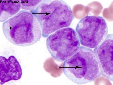 Acute Monocytic Leukemia Aml M5b Another Case Showing Promonocytes