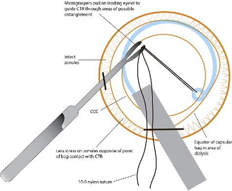 Figure 4 From Suture Guided Capsular Tension Ring Insertion To Reduce
