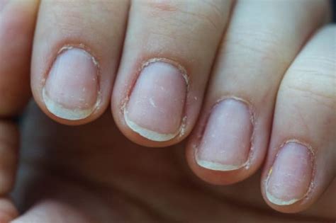Suffer From Brittle Nails Returning Your Nails To Health