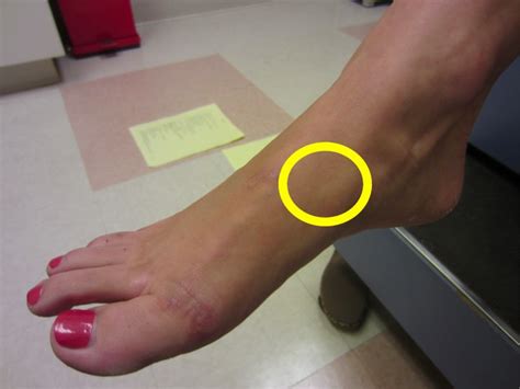 How To Tell If Top Of Foot Is Broken Broken Toe Fractures Treatment