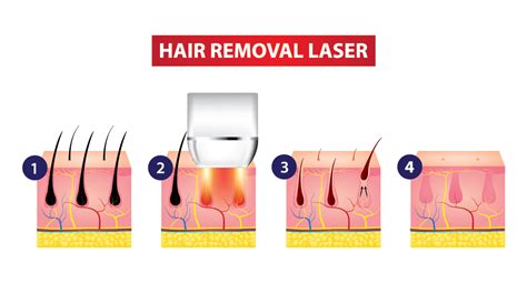 Top 48 Image How Dies Laser Hair Removal Work Vn