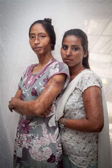 Indian Acid Attack Victims Share Their Stories Human Rights Al Jazeera