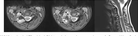 Figure 1 From Aneurysmal Bone Cyst Of The Cervical Spine Semantic