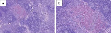 Lymphnode Pathology Features Prominent Germinal Centers And