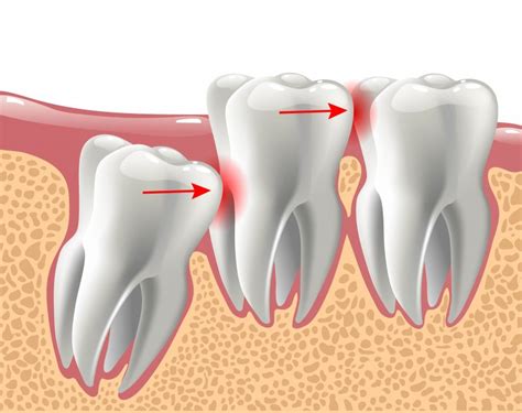 What Do You Do About Impacted Wisdom Teeth Premier Walk In Dental