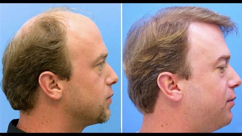 Learn about hair loss and causes of it.hair transplant centre has been treating hair loss over 10 years.transform yourself by start your journey with us. Hair Loss Treatment Coming South Korean Scientists Develop ...