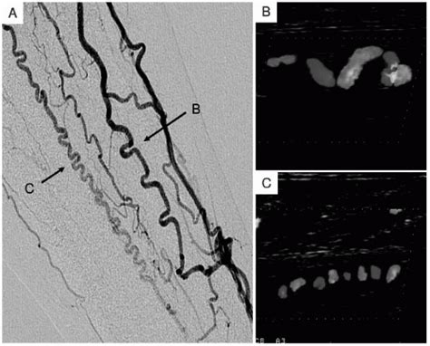 Buerger’s Disease (Thromboangiitis Obliterans) | Thoracic Key