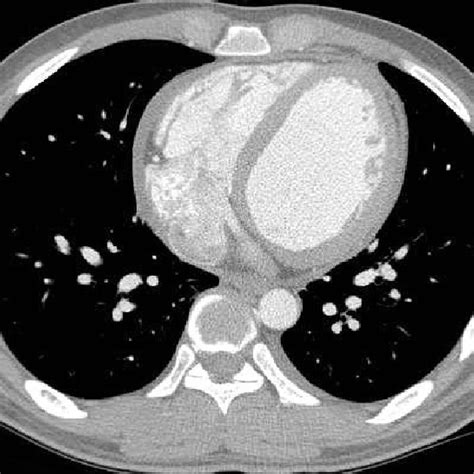 Pdf Primary Malignant Pericardial Mesothelioma Presenting As Acute