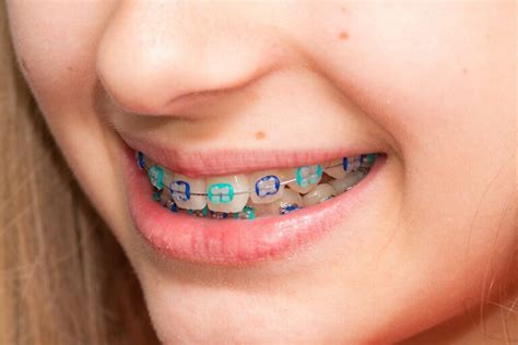 Choose The Best Colors For Your Braces【 2021 】good Colors And Ideas