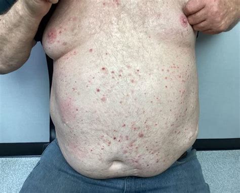 Dermdx Red Itchy Rash On Chest Clinical Advisor