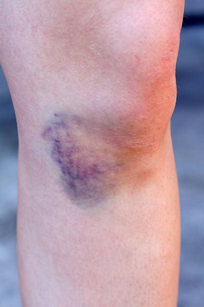 1300 Picture Of Hematoma Pictures Stock Photos Pictures And Royalty