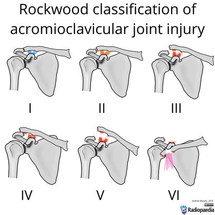 Acromioclavicular Injury Radiology Reference Article Radiopaedia Org