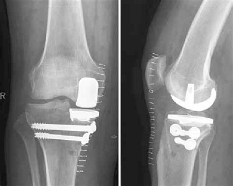 Figure 6 From Periprosthetic Fracture Of The Tibial Plateau After
