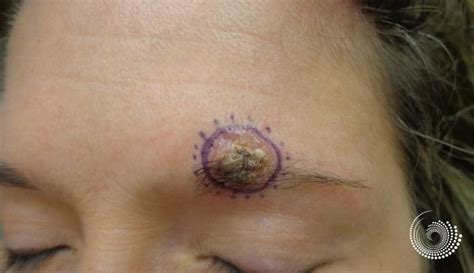 Basal Cell Skin Cancer Removal Near Eyebrow Mohs Surgery Before And After