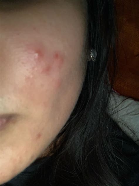 Acne Please Help Deep Painful Cystic Acne Breakouts All Over Cheeks