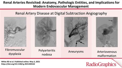 Renal Arteries Revisited Anatomy Pathologic Entities And