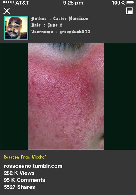 Rosacea From Alcohol 124343 Rosacea Free Forever