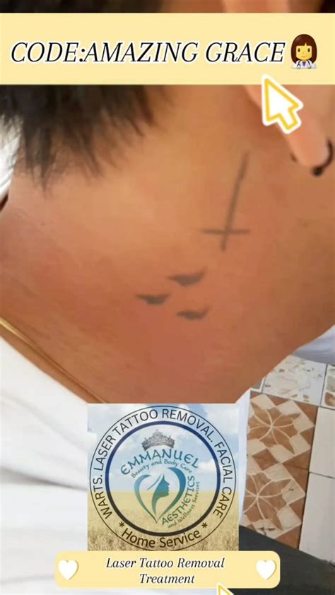 Laser Tattoo Removal Treatment Diminish Unwanted Tattoos Tiktok
