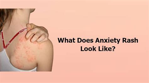 What Does Anxiety Rash Look Like Causes And Symptoms