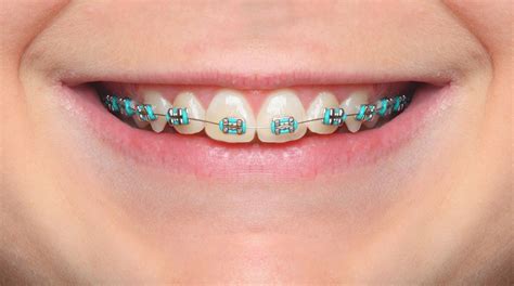Braces Colors That Make Your Teeth Look Whiter Braces Color