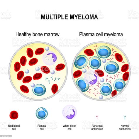 Multiple Myeloma Plasma Cell Myeloma Stock Illustration