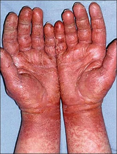 Contact Allergic Dermatitis