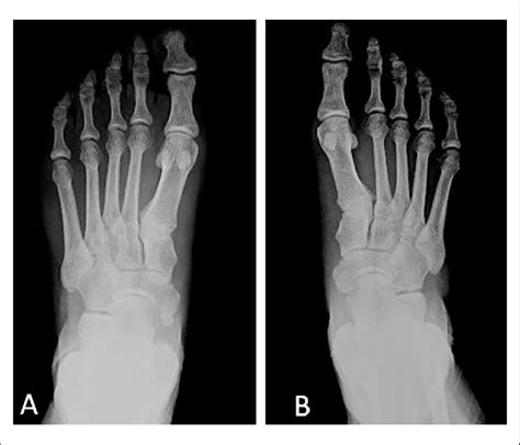 A Patients With Type 2 Unilateral Accessory Navicular Bone Anb On