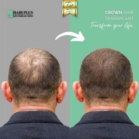 Crown Hair Transplant Hair Plus International