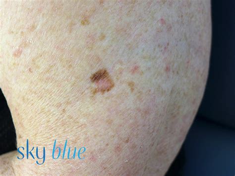 Melanoma Upper Arm 2b Close Up Sky Blue Dermatology