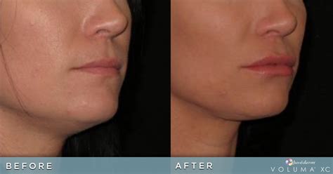 Lip Augmentation Before And After Photos Juvederm