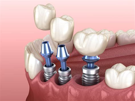Woodland Hills Dentist Explains How We Guide Implant Placement