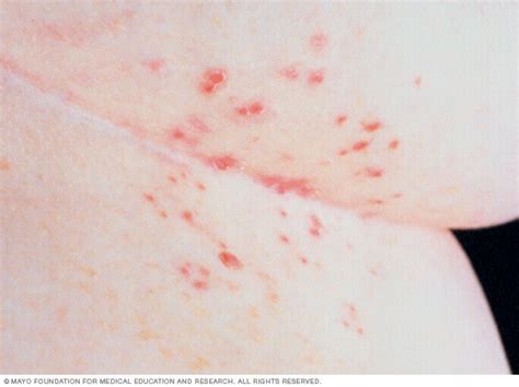 Scabies Symptoms And Causes Mayo Clinic
