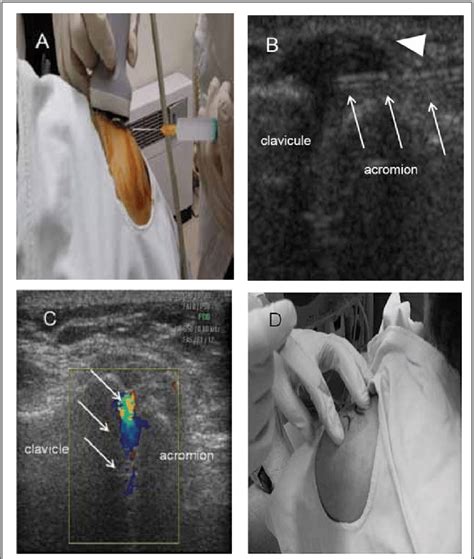 Us Guided Ac Joint Ia Injection Patients Are In The Seated Position