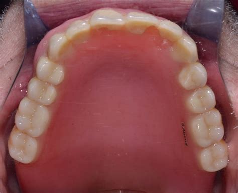 Implant Procedure By Dr Chaulong Los Altos Dental Excellence