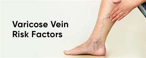 Here Are 6 Risk Factors For Varicose Veins